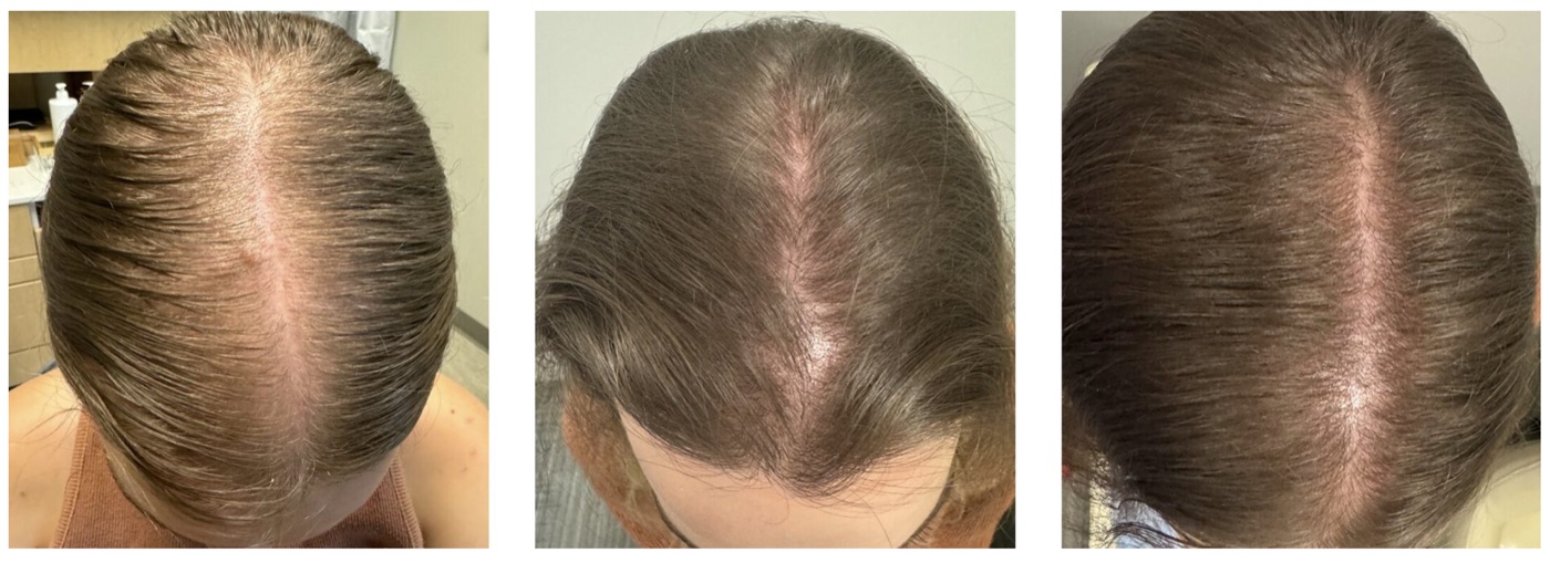 Three-stage progression of a female client's part line showing increasing density