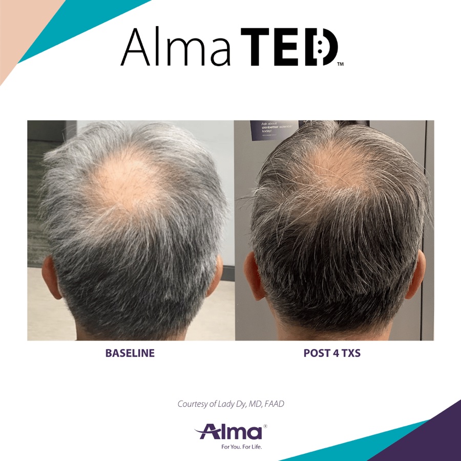 Alma TED before-and-after case study
