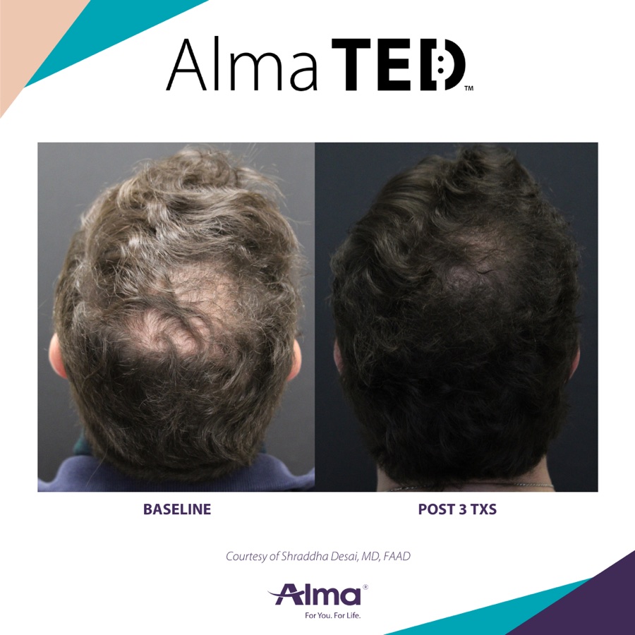 Alma TED before-and-after case study