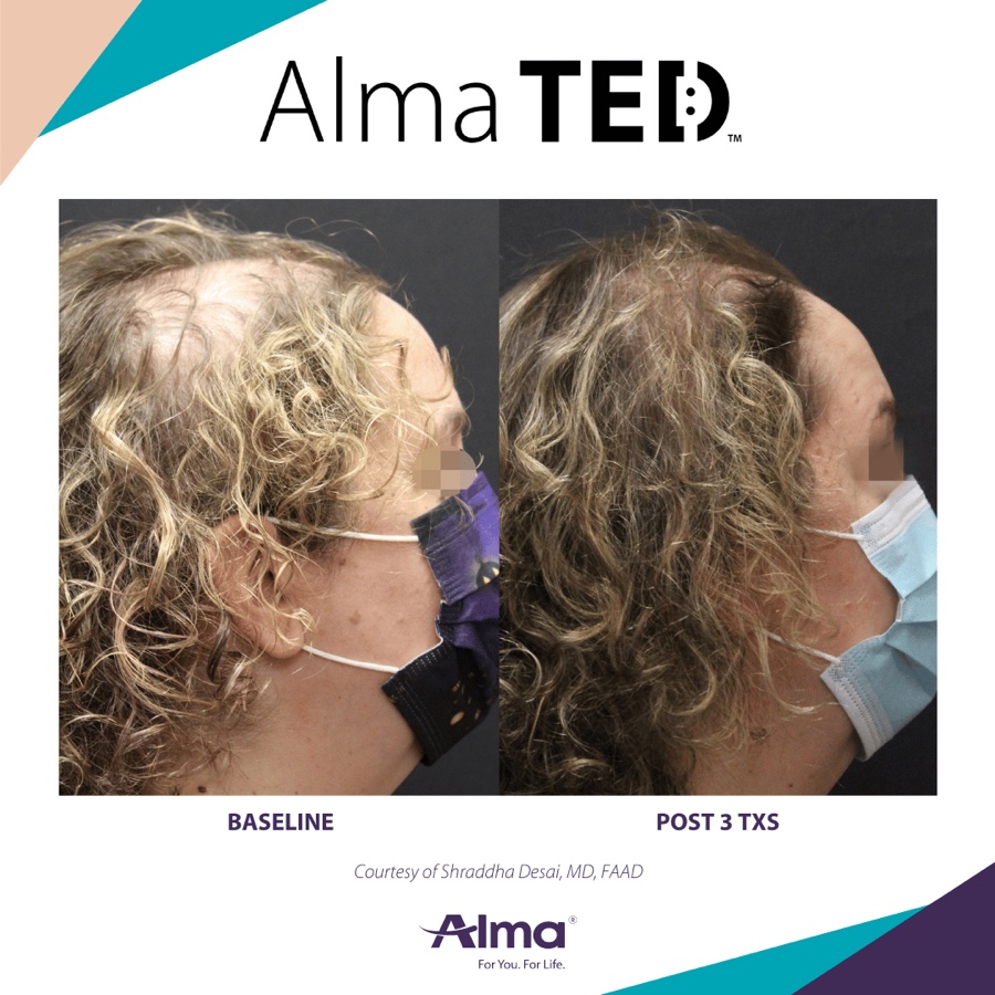 Alma TED before-and-after case study